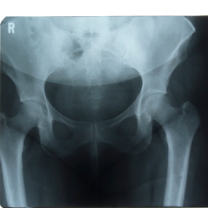 bone health